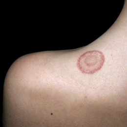 ringworm